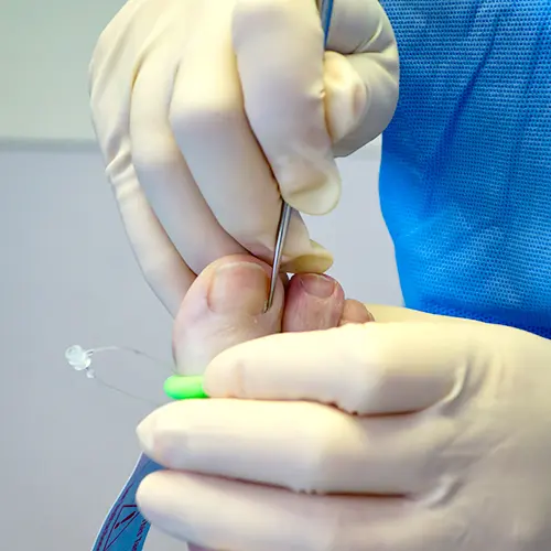 Podiatrist carrying out toenail surgery
